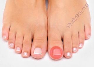 Toenail (Oops! image not found)